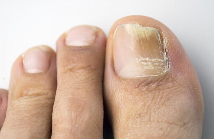 how-to-treat-toenail-fungus-with-vicks-healthy-lifestyle