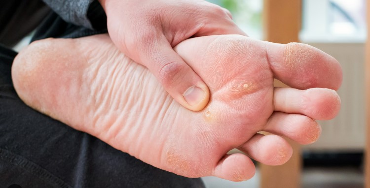 how-to-prevent-calluses-on-feet-best-5-toenail-clippers-2023