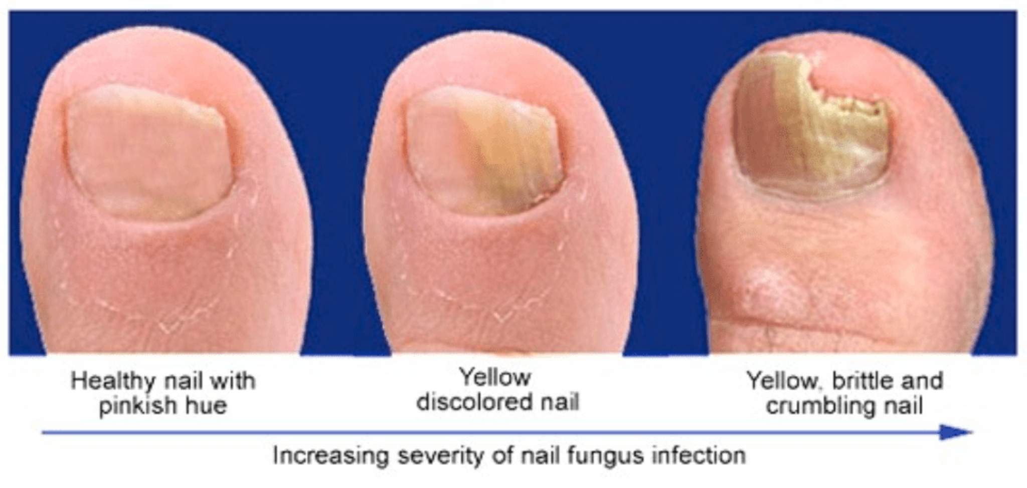 Is Toenail Fungus Contagious Nail Clippers Toenail Clippers And Nail Care